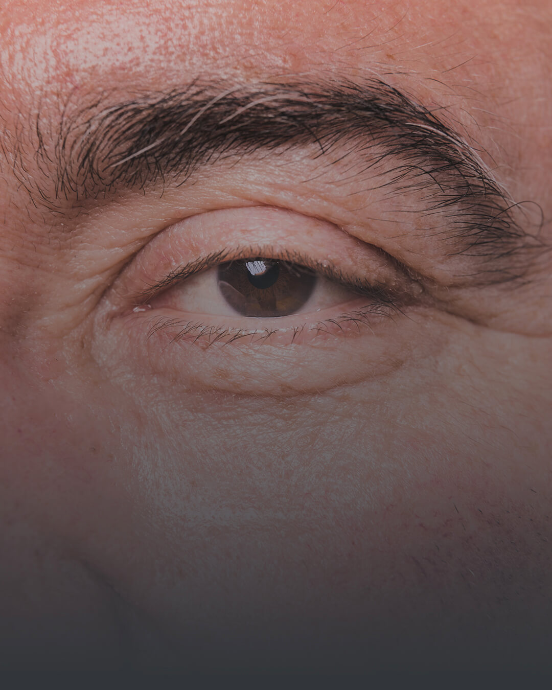 Samsun Entropion (Göz Kapaklarının İçe Dönmesi) Tedavisi