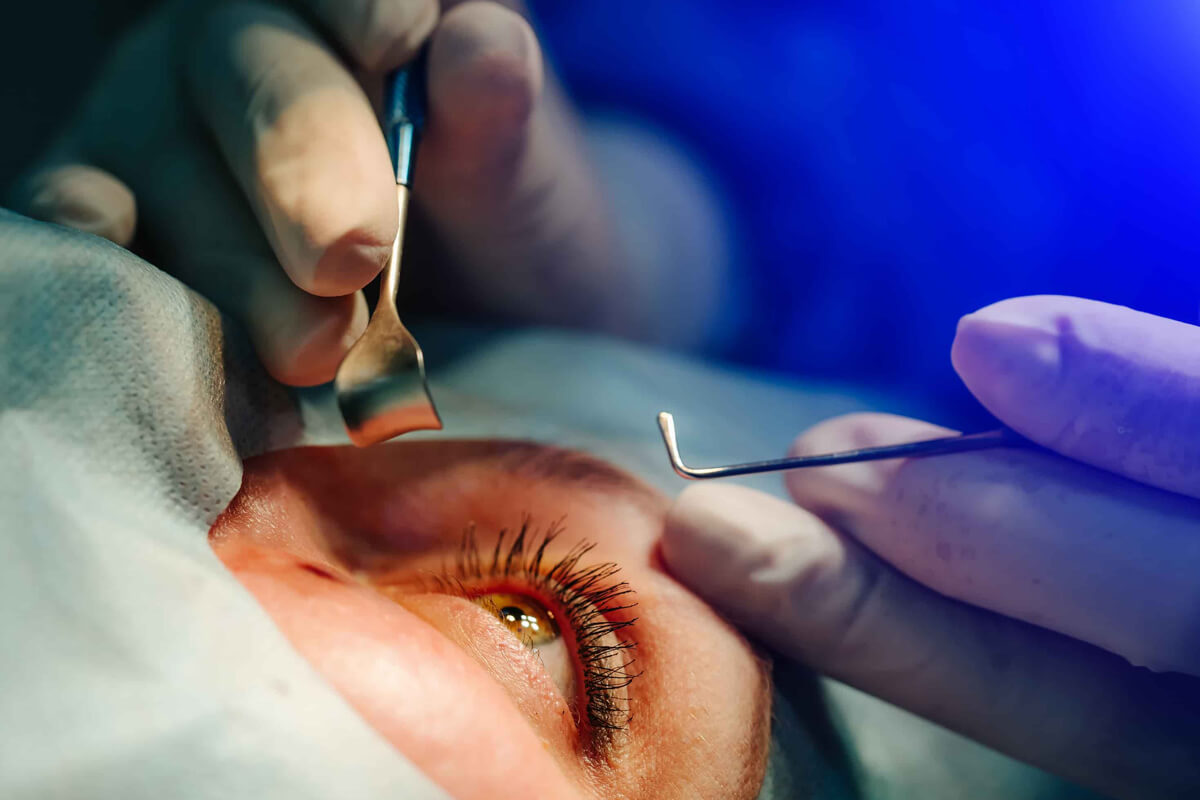 FAKO Yöntemi İle Katarakt Tedavisi Kimlere Uygulanır?