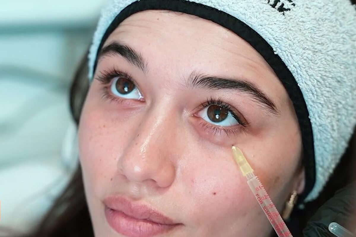 Göz Çevresi Mezoterapisi Faydaları