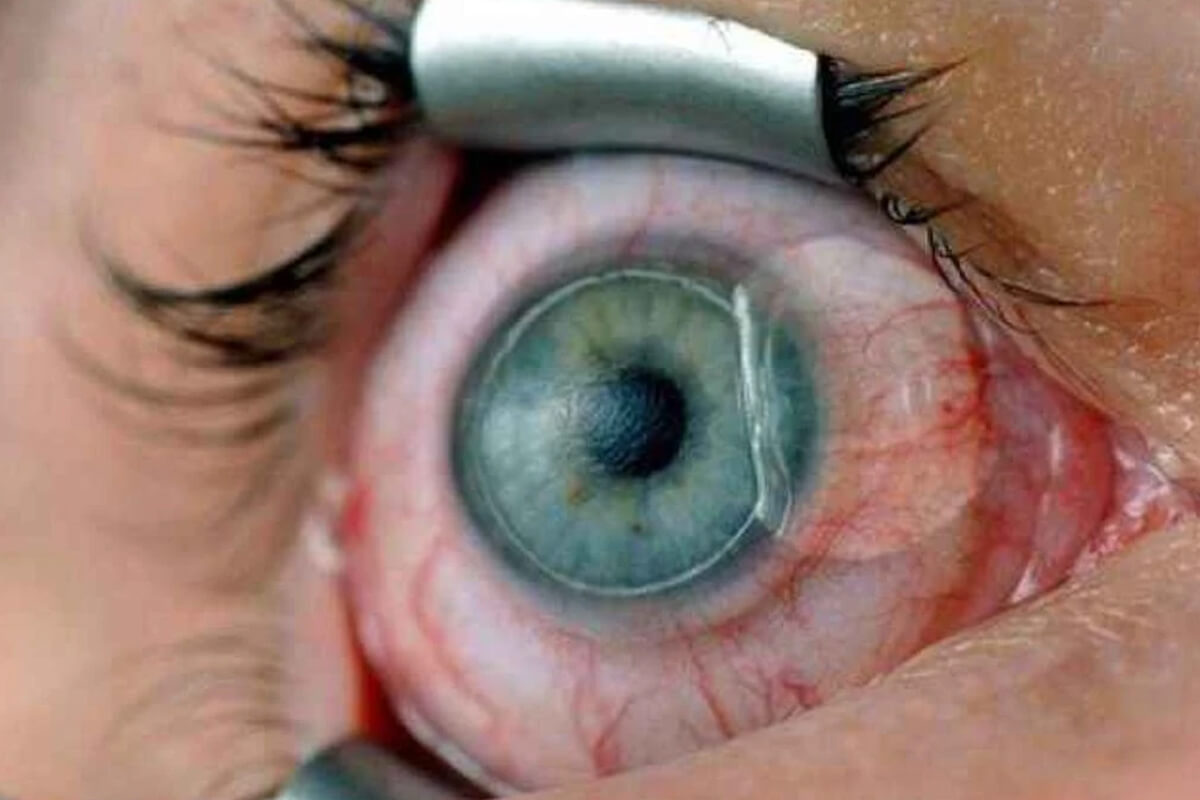 Göz Çizdirme Ameliyatı Şartları