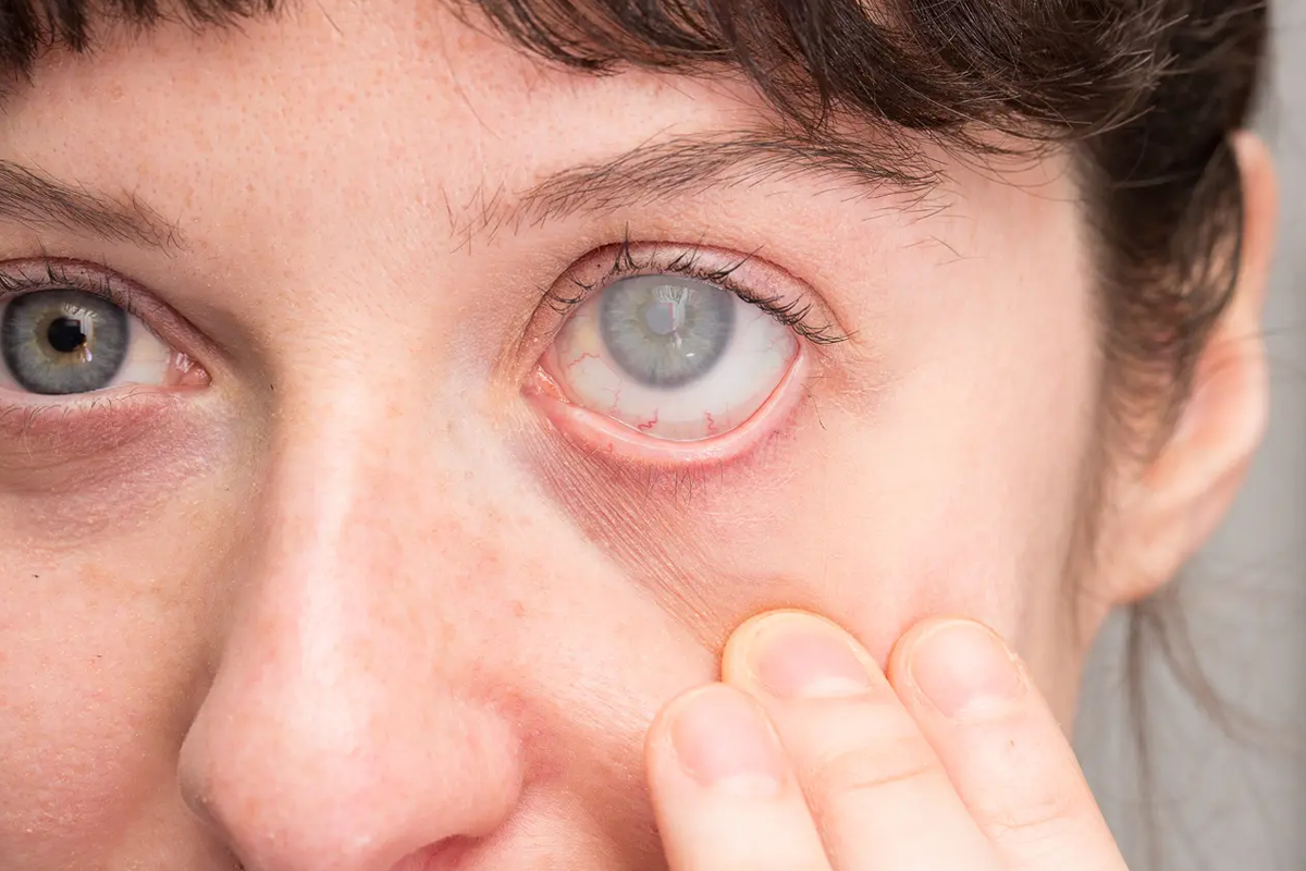 Göz Tansiyonu (Glokom) Belirtileri