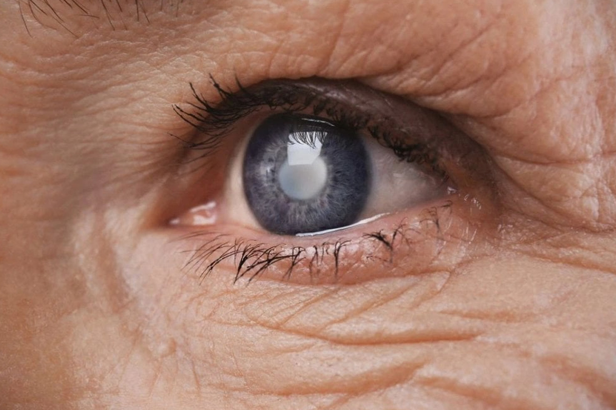 Göz Tansiyonu (Glokom) Tanısı Nasıl Konur?