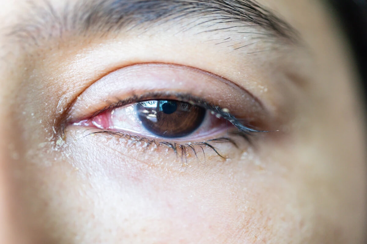 Gözyaşı Kanal Tıkanıklığı Kendiliğinden Açılır Mı?