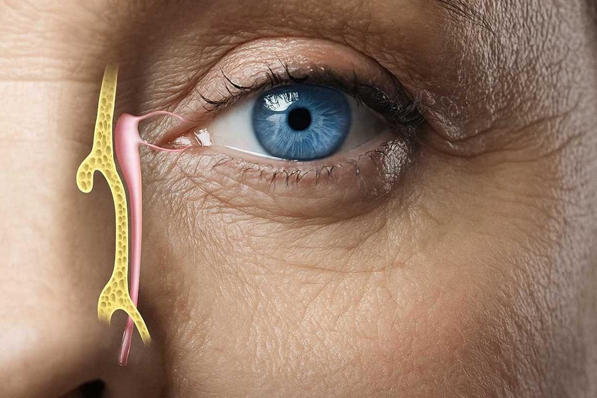 Gözyaşı Kanal Tıkanıklığı Sebepleri