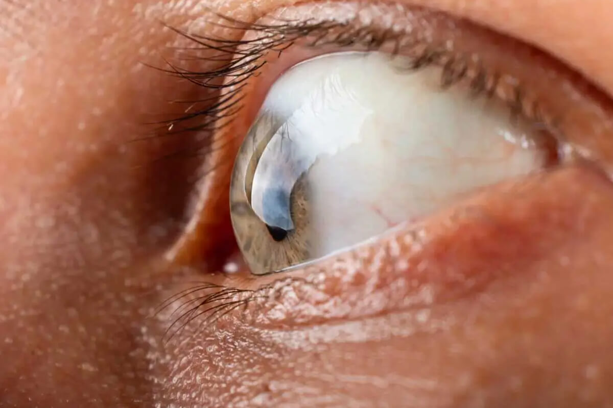 Kornea Hastalıkları Tedavi Fiyatları 2026