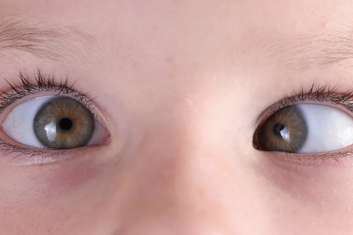 Pediatrik Oftalmoloji ve Şaşılık Belirtileri