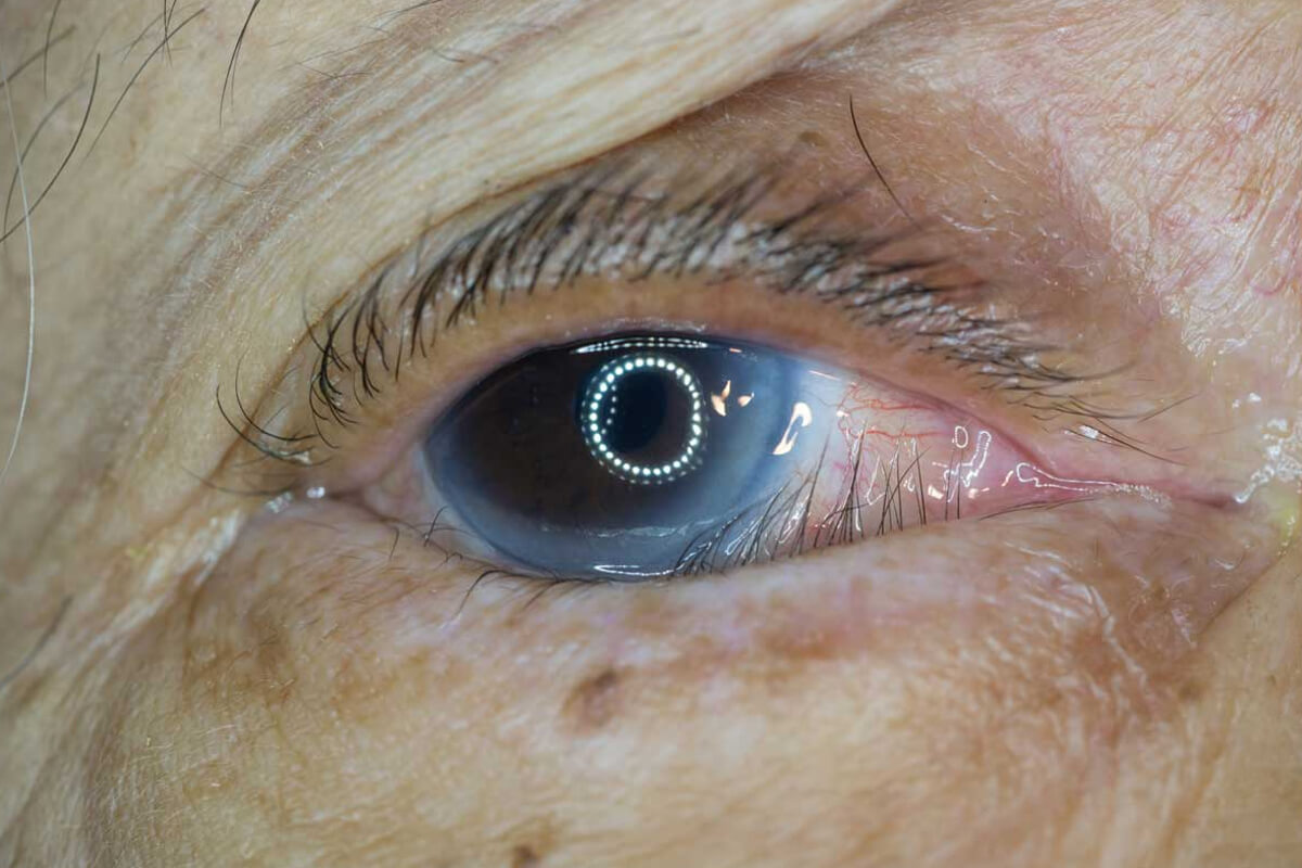 Samsun Entropion (Göz Kapaklarının İçe Dönmesi) Tedavisi