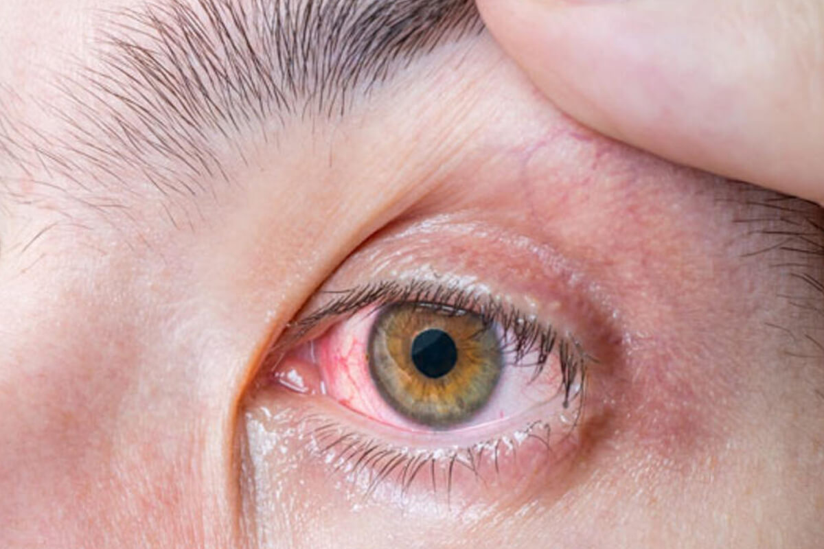 Samsun Gözyaşı Kanal Tıkanıklığı Tedavisi (DSR)