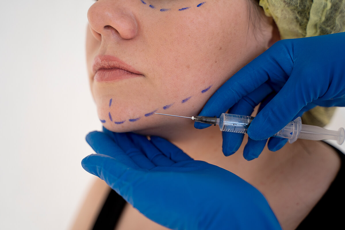 Samsun Jawline Dolgusu