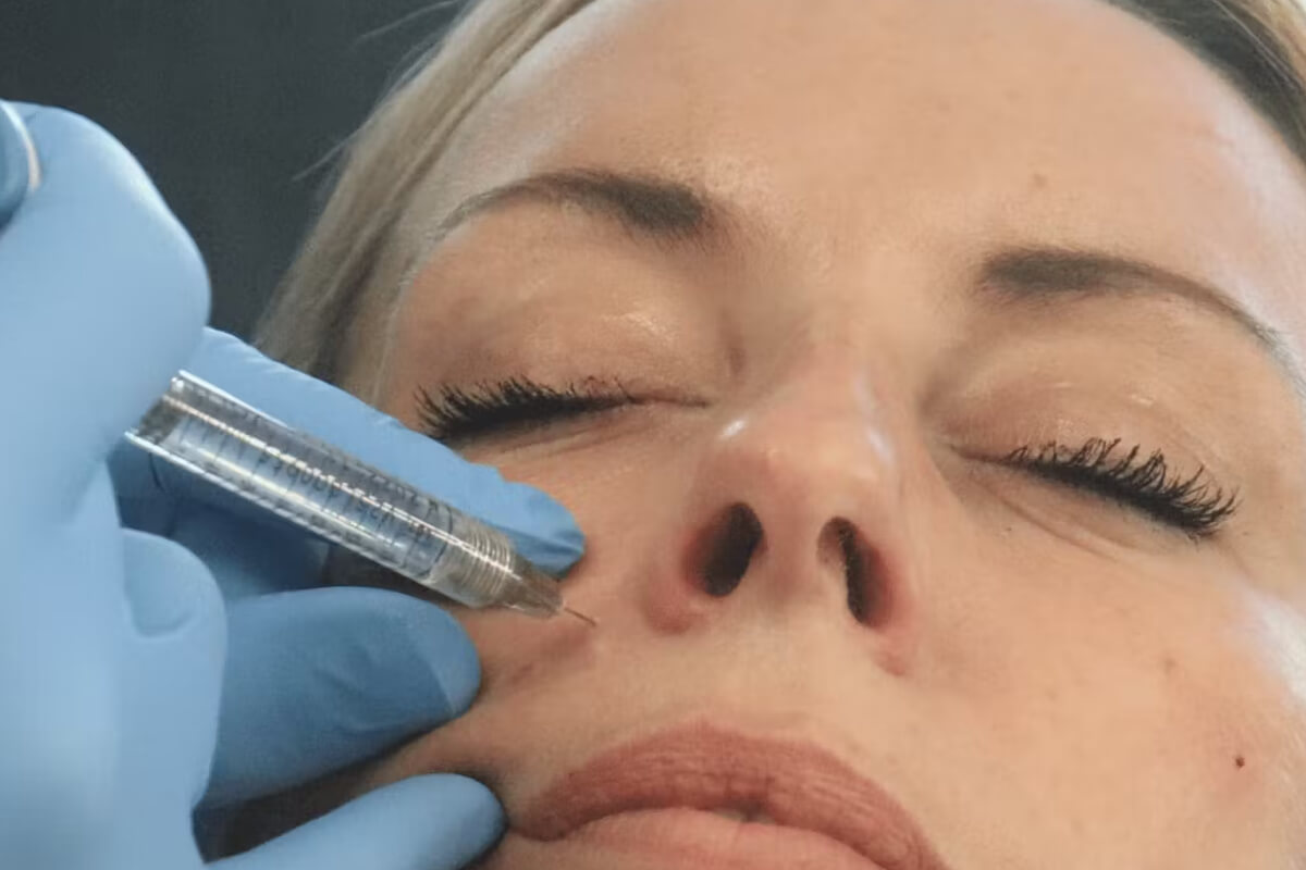 Samsun Nazolabial Dolgu