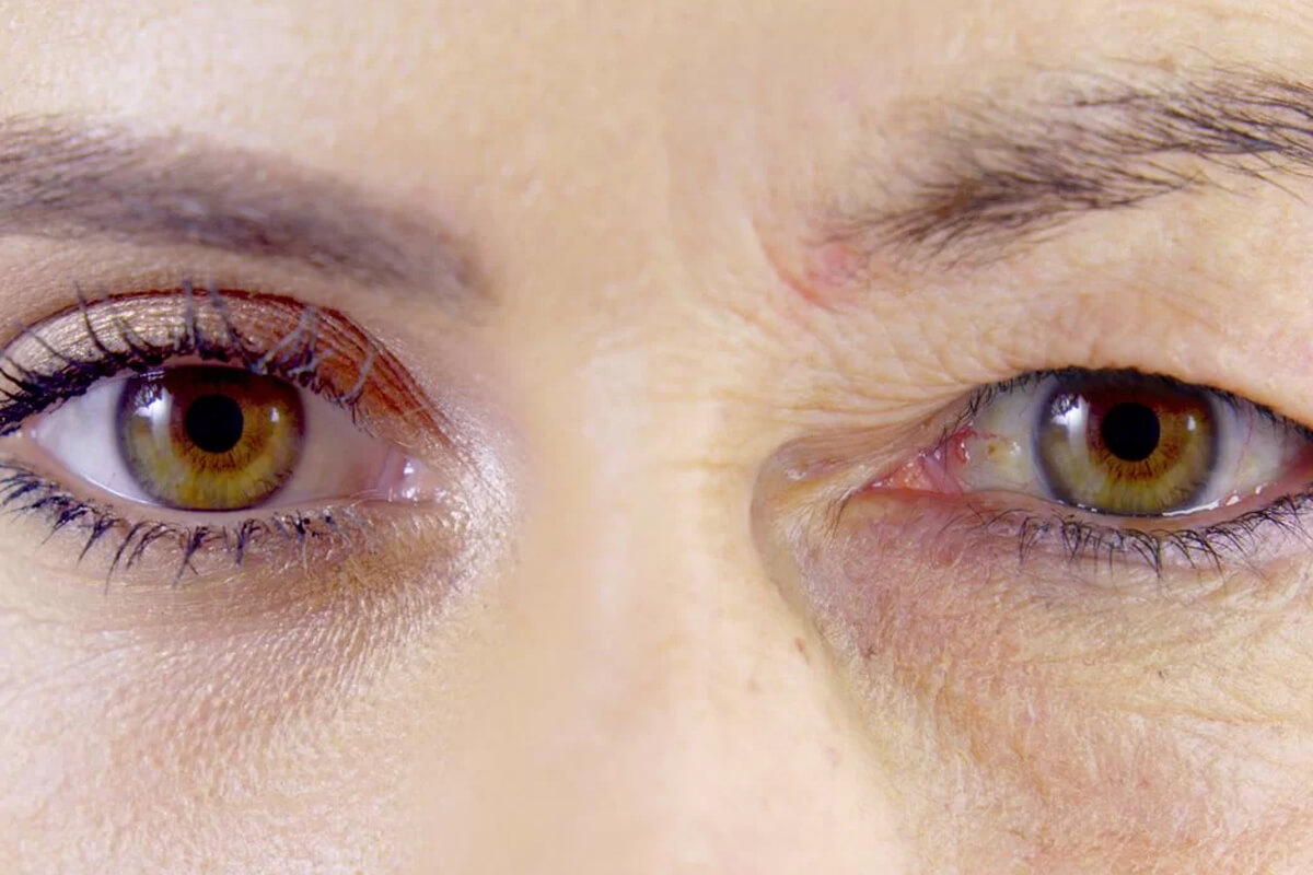 Samsun Pitozis (Göz Kapağı Düşüklüğü) Tedavisi