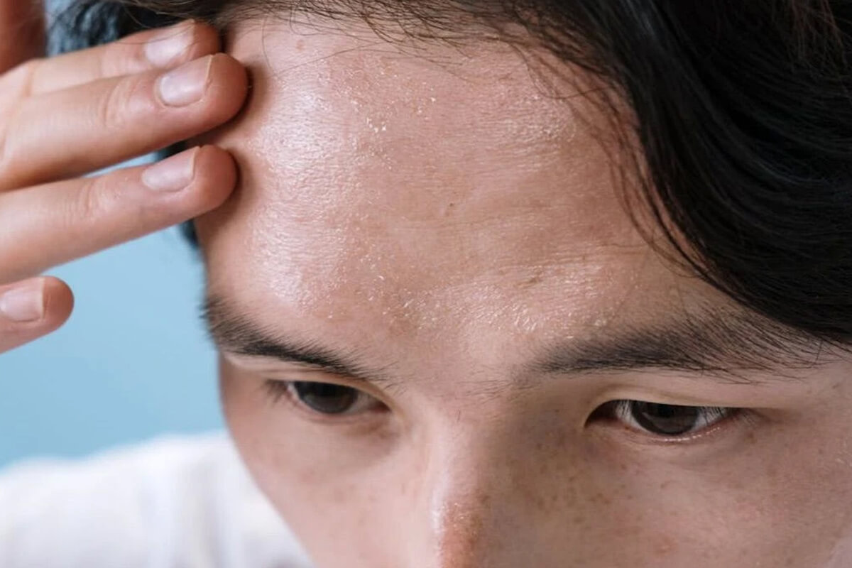 Terleme Botoksu Fiyatları 2026