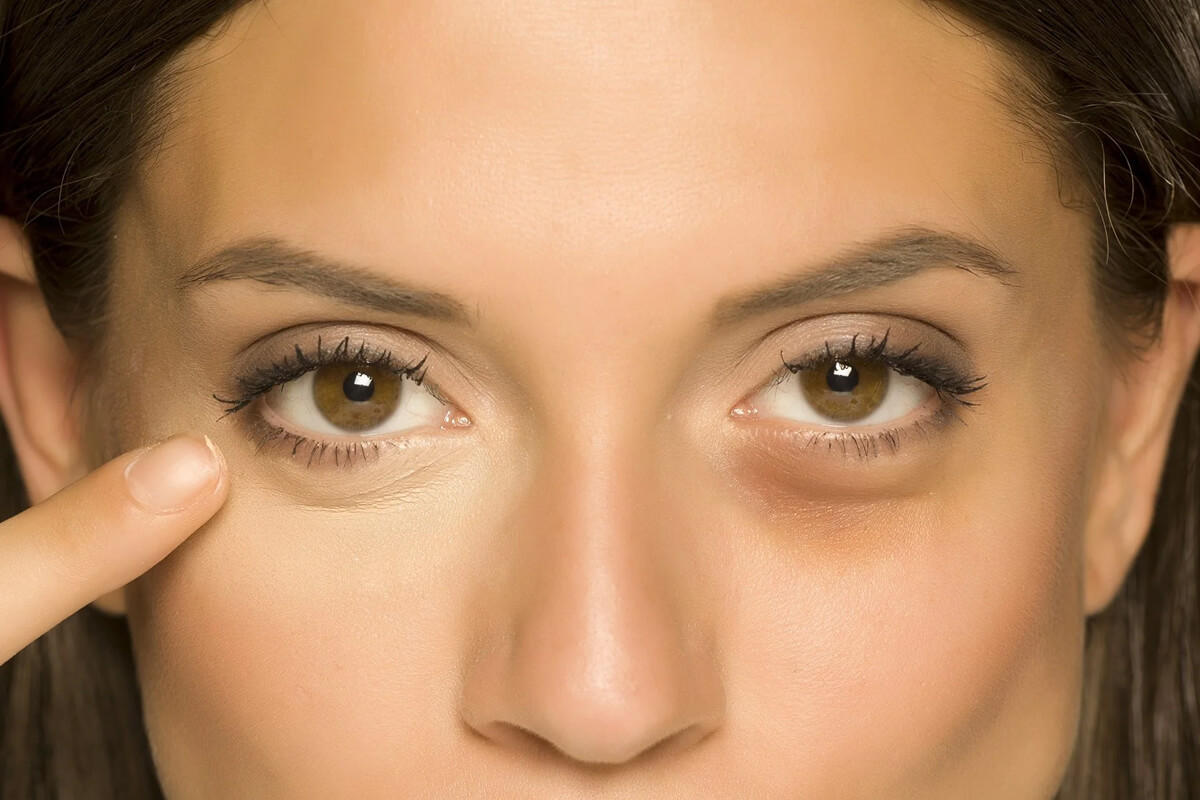 Göz Altı Torbaları Nasıl Geçer?