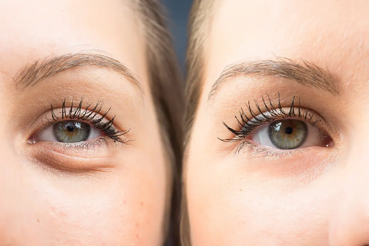 Göz Altı Torbaları Tedavi Yöntemleri