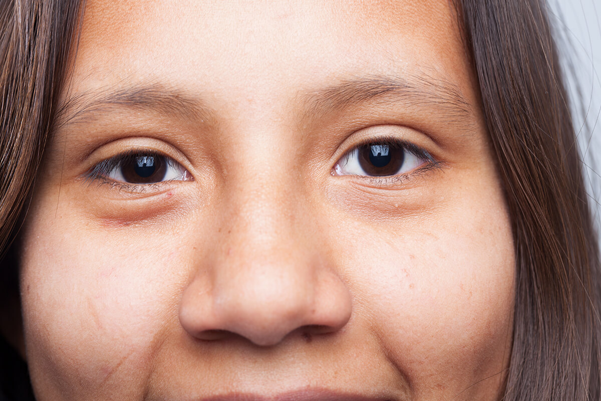 Göz Altı Torbaları Neden Olur? Ameliyatlı ve Ameliyatsız Tedavi Yöntemleri