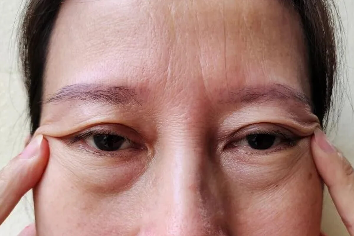 Göz Altı Torbası Ameliyatı İkinci Kez Yapılabilir mi?