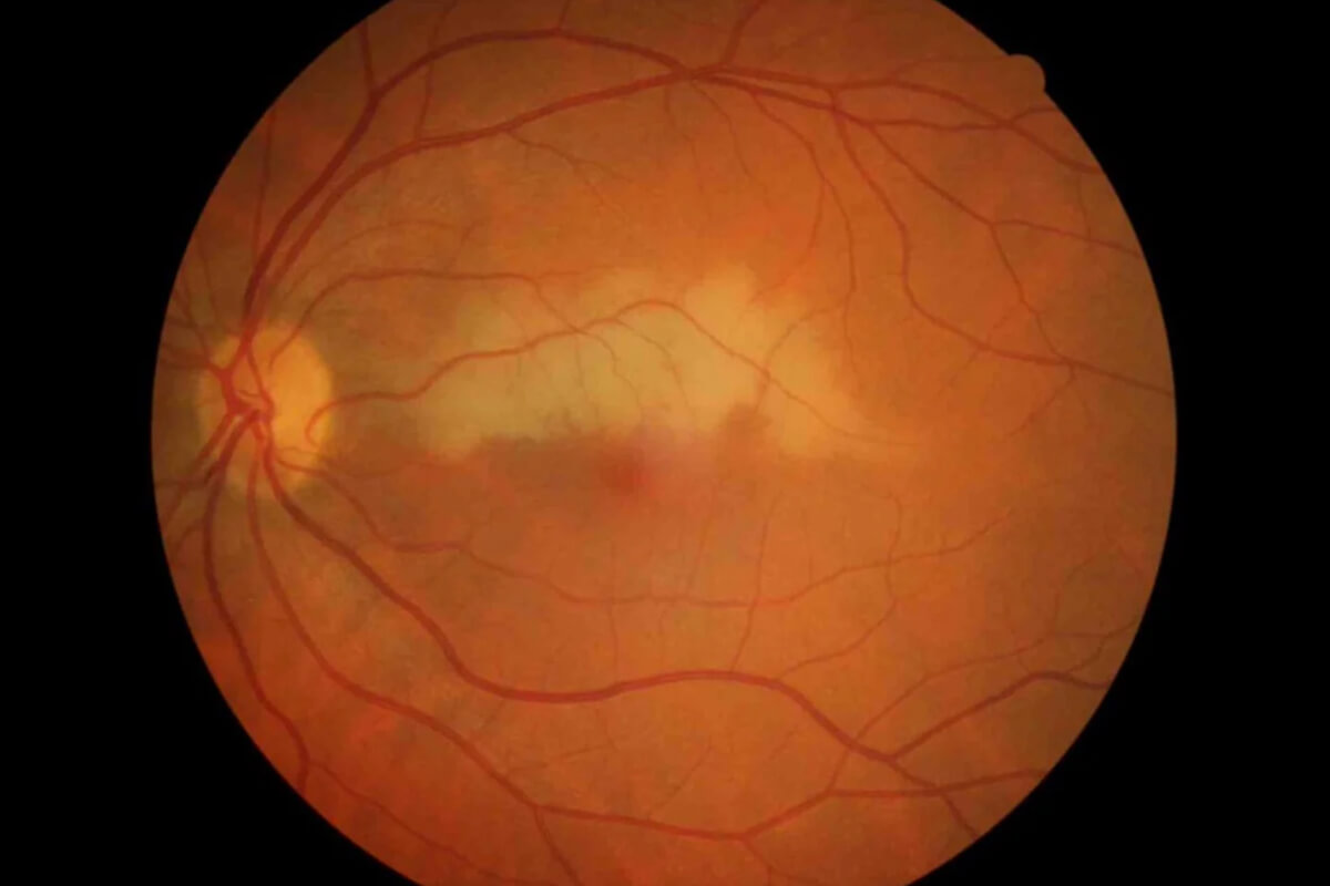 Retinal Arter Tıkanıklığı Belirtileri