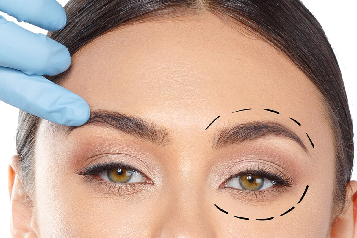 Yalancı Göz Kapağı Sarkması Nedir? (Kaş Düşüklüğünün Maskelemesi)